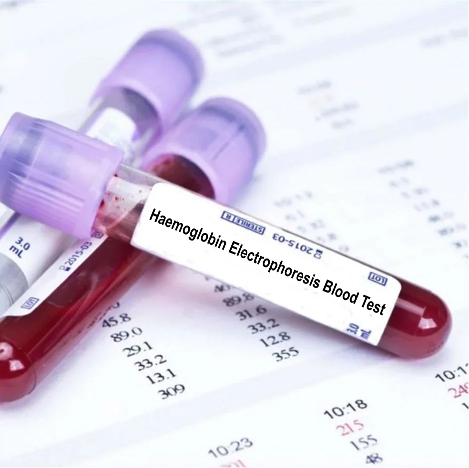 فحص Hb Electrophoresis