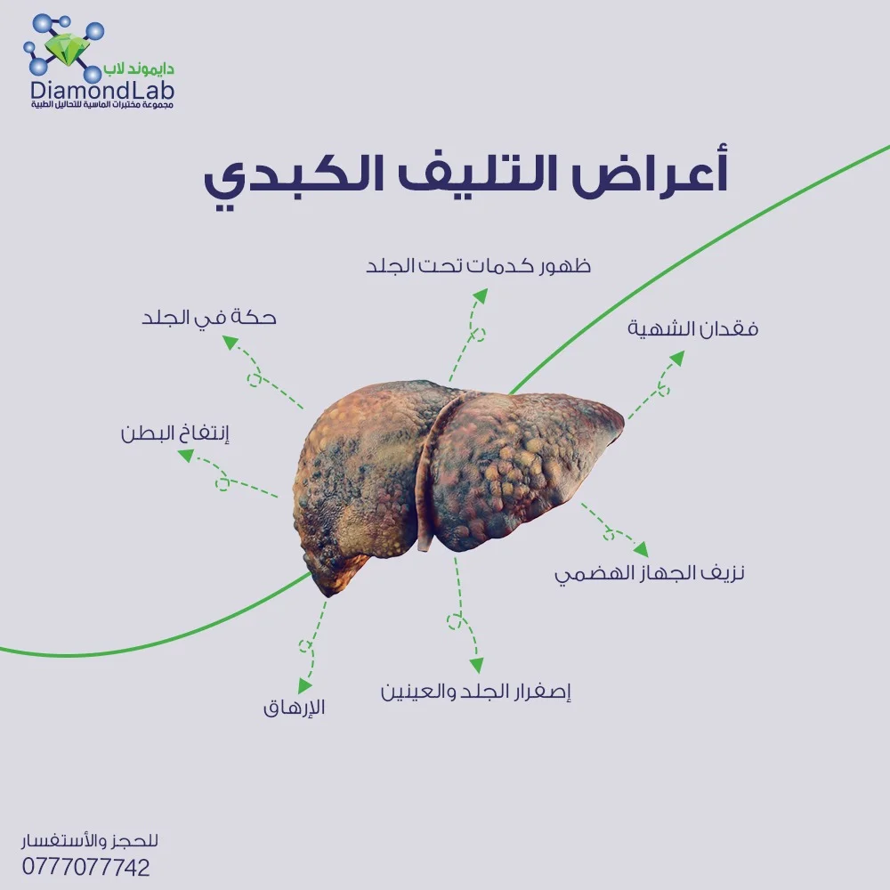 أعراض تليف الكبد