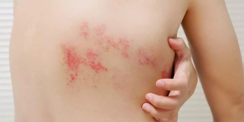ما هو الحزام الناري وما أعراضه؟
