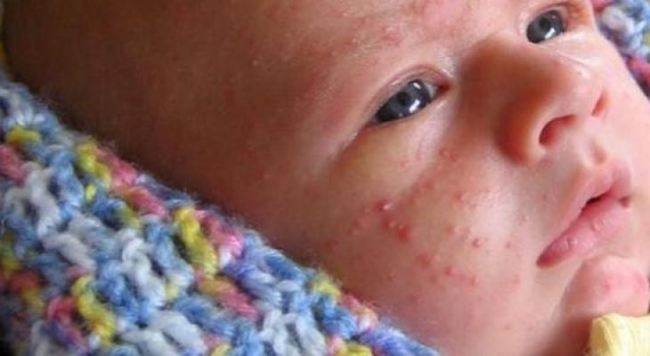ما هي أسباب ظهور حبوب حمراء صغيرة على وجه الرضيع؟